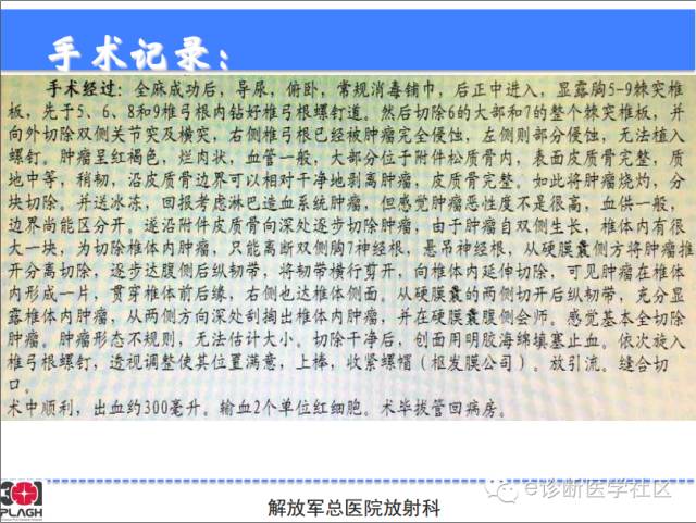 【病例】胸椎浆细胞瘤1例CT及MR影像表现