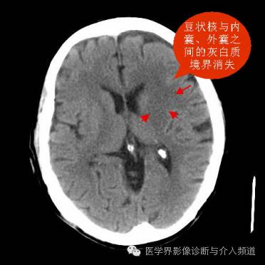超急性期脑梗塞CT征象