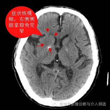 超急性期脑梗塞CT征象 超急性期脑梗塞CT征象
