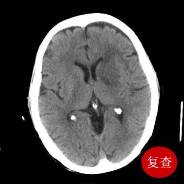 超急性期脑梗塞CT征象 超急性期脑梗塞CT征象
