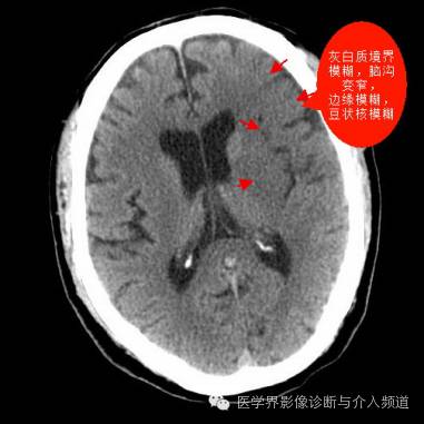 超急性期脑梗塞CT征象 超急性期脑梗塞CT征象