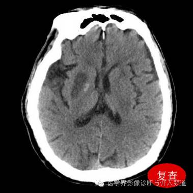 超急性期脑梗塞CT征象 超急性期脑梗塞CT征象
