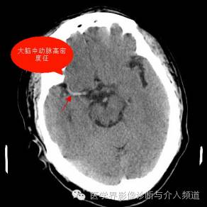 超急性期脑梗塞CT征象 超急性期脑梗塞CT征象
