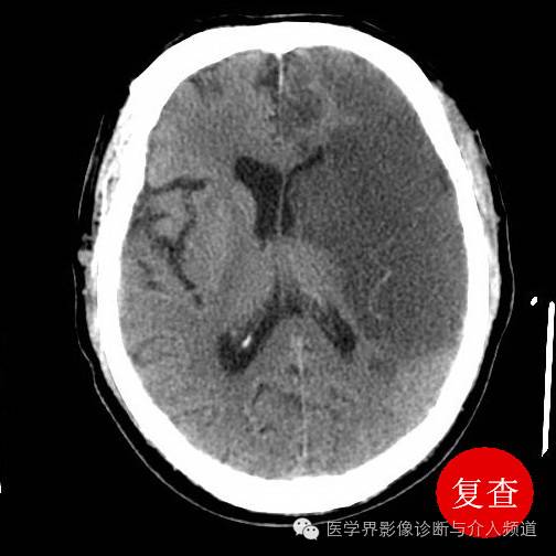 超急性期脑梗塞CT征象 超急性期脑梗塞CT征象