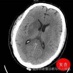 超急性期脑梗塞CT征象 超急性期脑梗塞CT征象