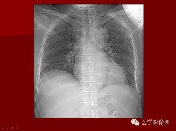 【病例】肺部韦格纳肉芽肿1例CT影像表现 【病例】肺部韦格纳肉芽肿1例CT影像表现
