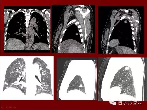 【病例】肺部韦格纳肉芽肿1例CT影像表现 【病例】肺部韦格纳肉芽肿1例CT影像表现