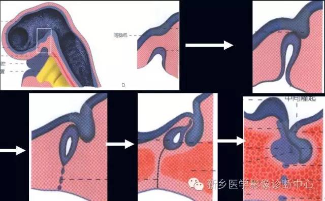 垂体柄阻断综合征 垂体柄阻断综合征