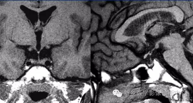 垂体柄阻断综合征 垂体柄阻断综合征