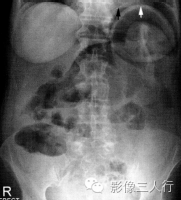 "双泡征"，这个征象提示啥？