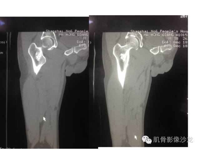 【病例】右股骨粗隆骨母细胞瘤1例