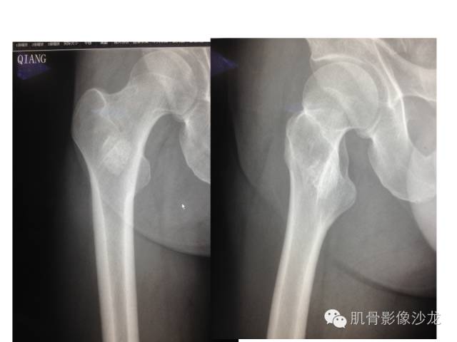 【病例】右股骨粗隆骨母细胞瘤1例