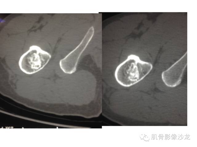 【病例】右股骨粗隆骨母细胞瘤1例