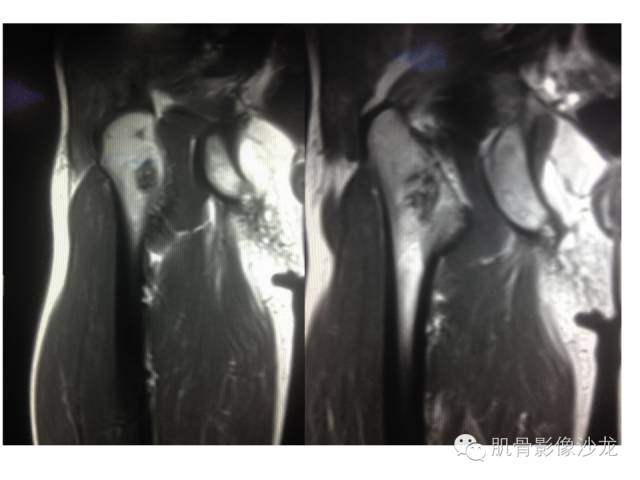 【病例】右股骨粗隆骨母细胞瘤1例
