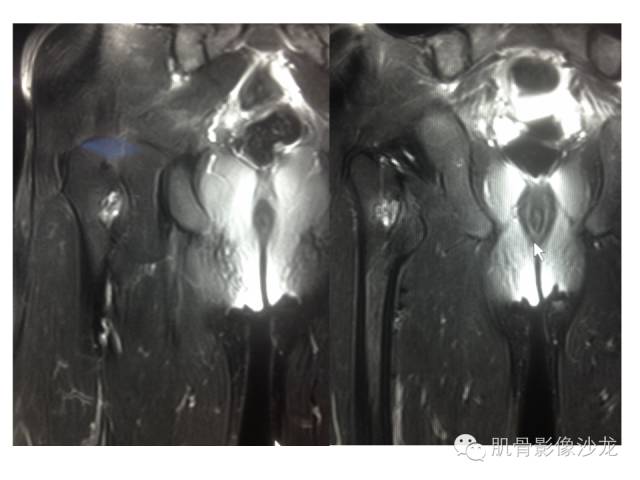 【病例】右股骨粗隆骨母细胞瘤1例
