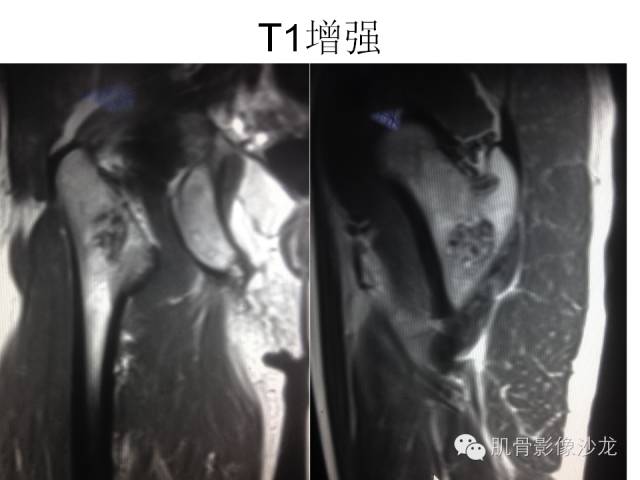 【病例】右股骨粗隆骨母细胞瘤1例