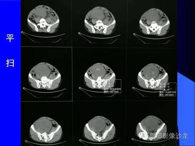 【病例】腹腔促结缔组织增生性纤维母细胞瘤1例CT影像表现 【病例】腹腔促结缔组织增生性纤维母细胞瘤1例CT影像表现