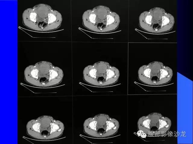 【病例】腹腔促结缔组织增生性纤维母细胞瘤1例CT影像表现 【病例】腹腔促结缔组织增生性纤维母细胞瘤1例CT影像表现
