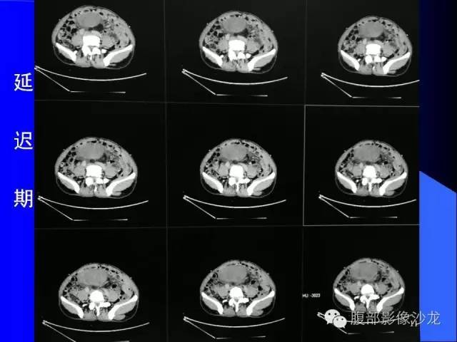 【病例】腹腔促结缔组织增生性纤维母细胞瘤1例CT影像表现 【病例】腹腔促结缔组织增生性纤维母细胞瘤1例CT影像表现
