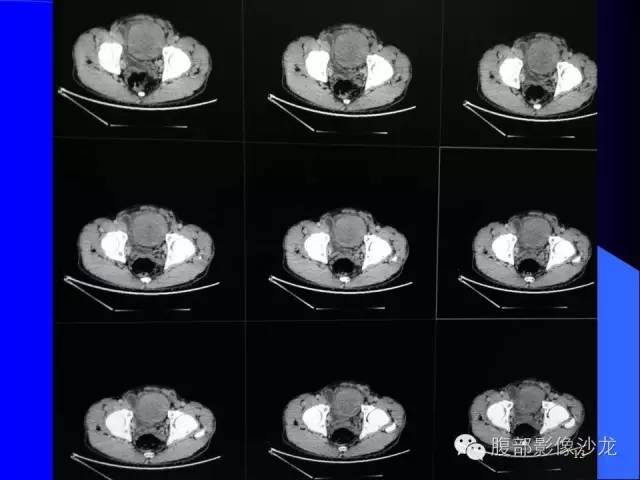 【病例】腹腔促结缔组织增生性纤维母细胞瘤1例CT影像表现 【病例】腹腔促结缔组织增生性纤维母细胞瘤1例CT影像表现