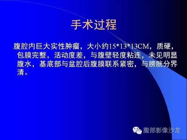 【病例】腹腔促结缔组织增生性纤维母细胞瘤1例CT影像表现 【病例】腹腔促结缔组织增生性纤维母细胞瘤1例CT影像表现
