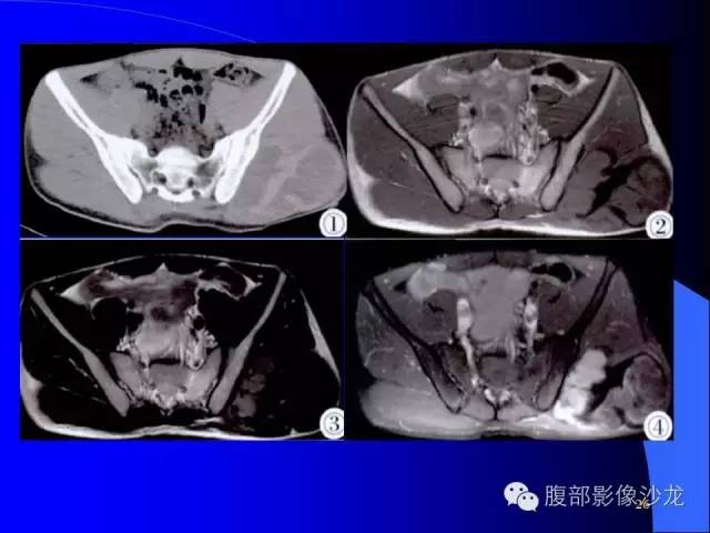 【病例】腹腔促结缔组织增生性纤维母细胞瘤1例CT影像表现 【病例】腹腔促结缔组织增生性纤维母细胞瘤1例CT影像表现