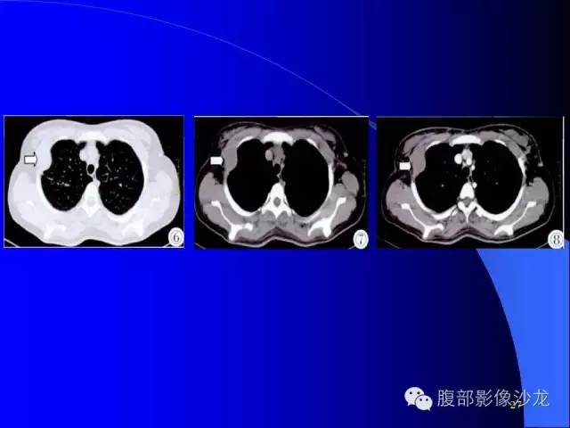 【病例】腹腔促结缔组织增生性纤维母细胞瘤1例CT影像表现 【病例】腹腔促结缔组织增生性纤维母细胞瘤1例CT影像表现
