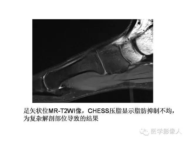 【PPT】肌骨系统MR成像脂肪抑制技术