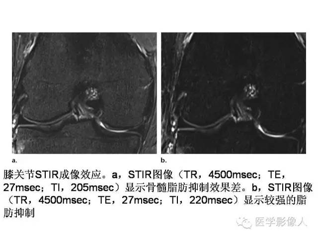 【PPT】肌骨系统MR成像脂肪抑制技术