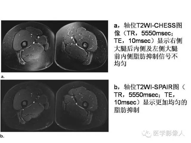 【PPT】肌骨系统MR成像脂肪抑制技术