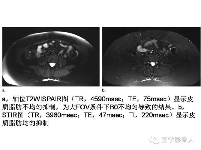 【PPT】肌骨系统MR成像脂肪抑制技术