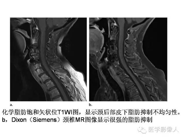 【PPT】肌骨系统MR成像脂肪抑制技术