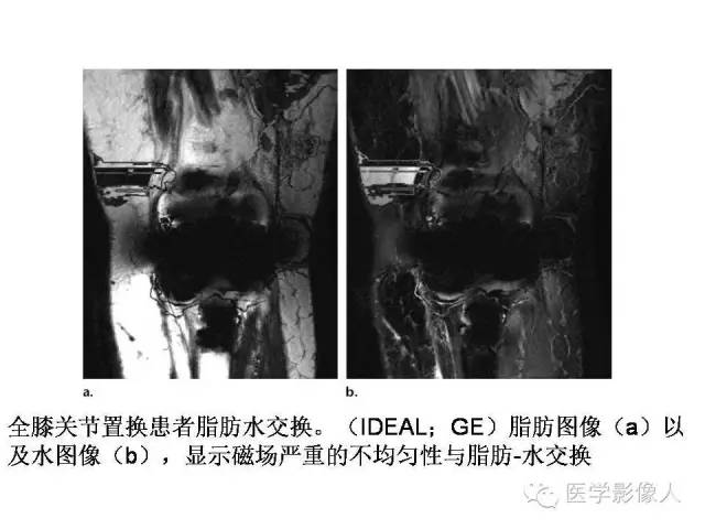 【PPT】肌骨系统MR成像脂肪抑制技术