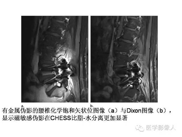 【PPT】肌骨系统MR成像脂肪抑制技术