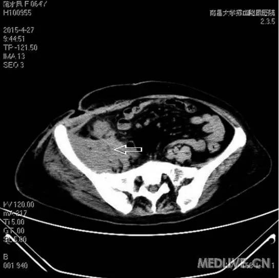 【病例】右侧髂腹部脓肿腹壁窦道形成为主要表现的回盲部结肠癌一例 【病例】右侧髂腹部脓肿腹壁窦道形成为主要表现的回盲部结肠癌一例