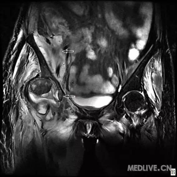 【病例】右侧髂腹部脓肿腹壁窦道形成为主要表现的回盲部结肠癌一例 【病例】右侧髂腹部脓肿腹壁窦道形成为主要表现的回盲部结肠癌一例