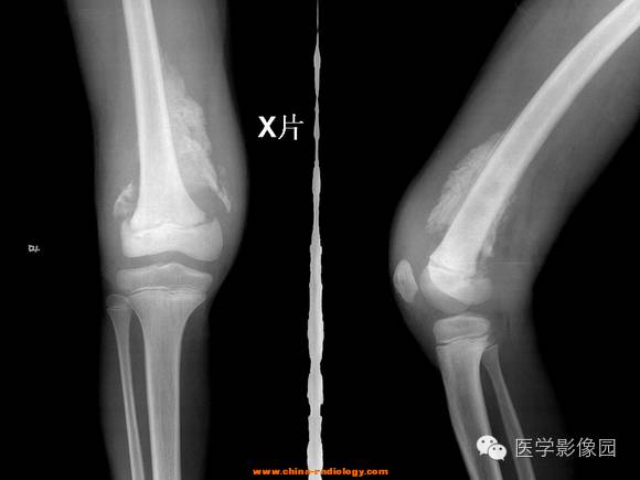 【病例】夏科氏关节1例X线及MR影像表现 【病例】夏科氏关节1例X线及MR影像表现