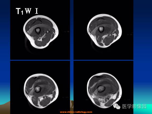 【病例】夏科氏关节1例X线及MR影像表现 【病例】夏科氏关节1例X线及MR影像表现