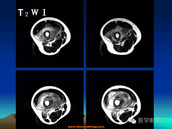 【病例】夏科氏关节1例X线及MR影像表现 【病例】夏科氏关节1例X线及MR影像表现