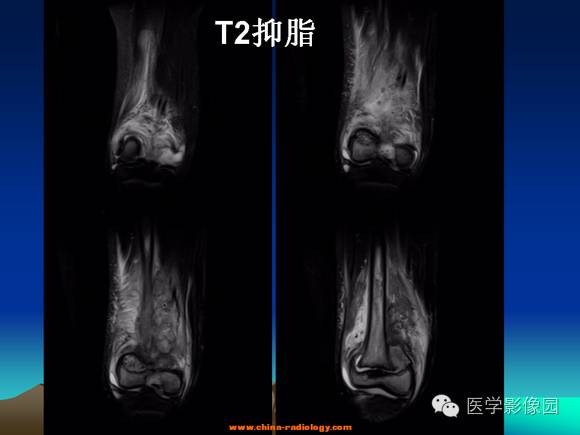 【病例】夏科氏关节1例X线及MR影像表现 【病例】夏科氏关节1例X线及MR影像表现