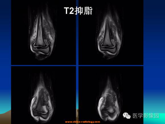 【病例】夏科氏关节1例X线及MR影像表现 【病例】夏科氏关节1例X线及MR影像表现