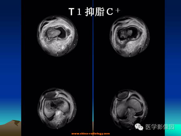 【病例】夏科氏关节1例X线及MR影像表现 【病例】夏科氏关节1例X线及MR影像表现