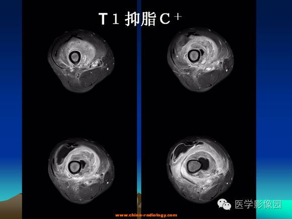【病例】夏科氏关节1例X线及MR影像表现 【病例】夏科氏关节1例X线及MR影像表现