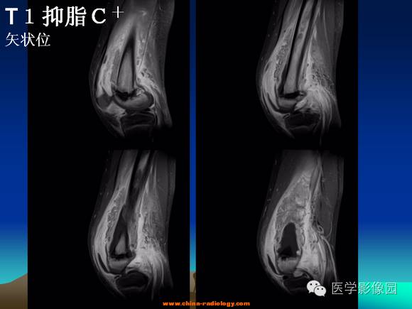 【病例】夏科氏关节1例X线及MR影像表现 【病例】夏科氏关节1例X线及MR影像表现