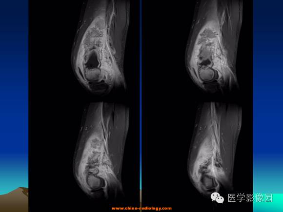 【病例】夏科氏关节1例X线及MR影像表现 【病例】夏科氏关节1例X线及MR影像表现
