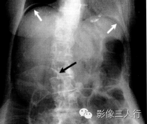 "Rigler征"，这个征象提示啥？