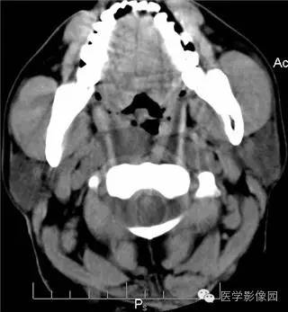 【病例】颈部多发性