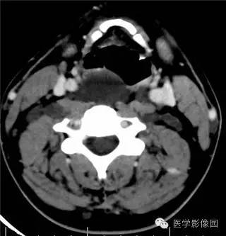【病例】颈部多发性