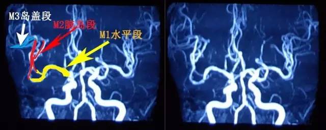 手把手教会阅读颅脑MRA和CTA 手把手教会阅读颅脑MRA和CTA