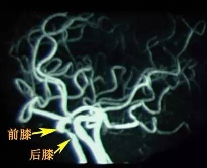 手把手教会阅读颅脑MRA和CTA 手把手教会阅读颅脑MRA和CTA